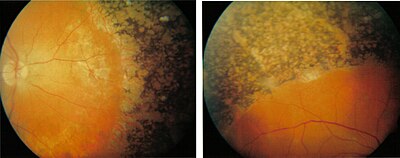 retinopátia jelentése