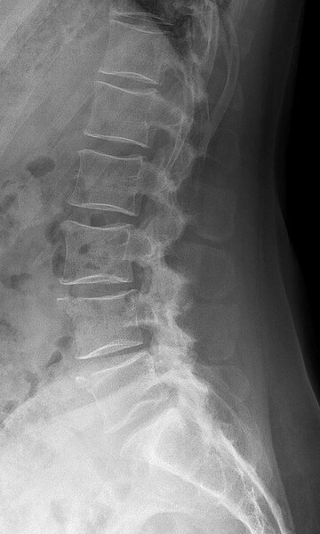 File:Limbus vertebrae LWK 4 und 5 53W - CR seitlich - 001.jpg