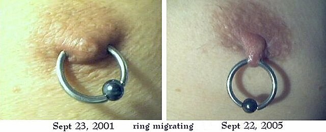 Two side-by-side photos of male nipple, first with captive-bead ring properly in place, second with same nipple and ring, the ring having on its own moved outward to having barely enough nipple into which to hang