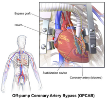 Off-pump coronary artery bypass (beating heart surgery) OPCAB.png