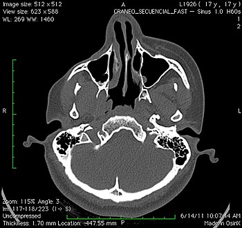 An axial CT scan of a 17-year-old girl with Parry–Romberg syndrome, showing severe loss of subcutaneous tissue and muscle of the right side of the face, with no apparent involvement of the facial bones