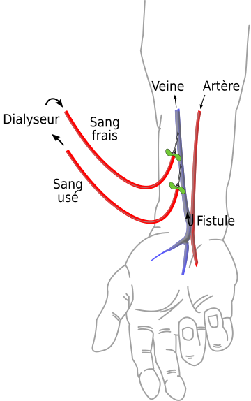 Fistule