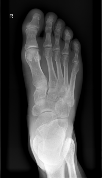 File:Right Foot of Male human 38 years old top view.png