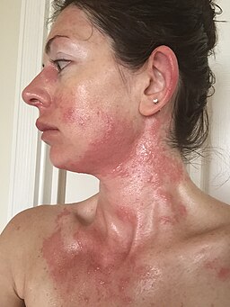 Severe allergic reaction to urushiol (poison oak) 4 days after exposure