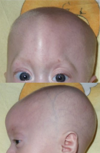 <span class="mw-page-title-main">Trigonocephaly</span> Congenital condition of premature fusion of the metopic suture