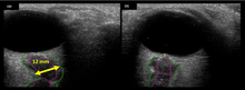 Figure 6: On-orbit ultrasound of optic nerves of the fourth case of visual changes from long-duration spaceflight. In-flight ultrasound shows proximal kinking and increased optic nerve sheath diameter (ONSD) of approximately 12 mm that is consistent with raised ICPs. Optic nerve shown in purple and the ONSD in green. VIIP Figure 6.png