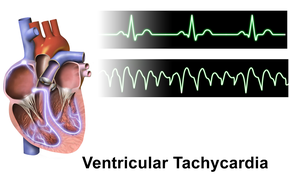 Normal sinus top, ventricular tachycardia bottom Ventricular Tachycardia.png