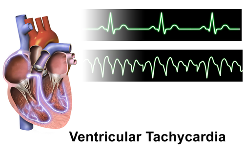 Ventricular Tachycardia.png