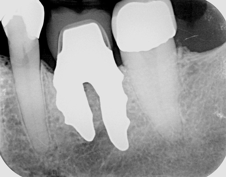File:X-ray of root analogue dental implant two rooted left lower molar.jpg