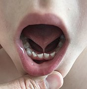 Ankyloglossia 1.jpg