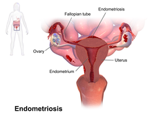 Blausen 0349 Endometriosis.png