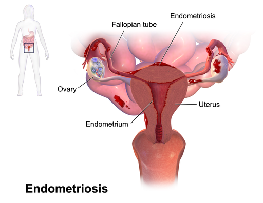 Darstellung der Gebärmutter und möglicher Endometrioseherde