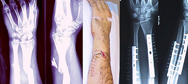 Bone Fractures: Types, Symptoms & Treatment