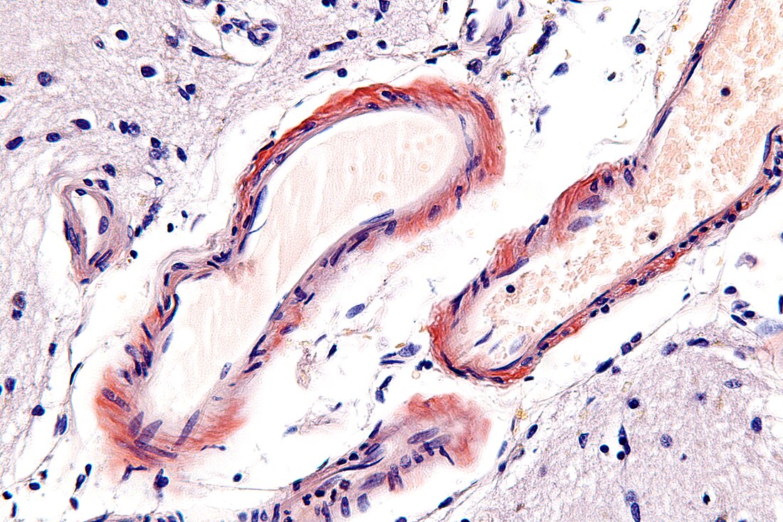 Angiopatía amiloide cerebral