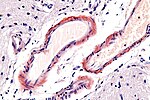 Thumbnail for Cerebral amyloid angiopathy
