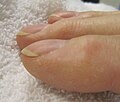 Nail Clubbing Wikipedia