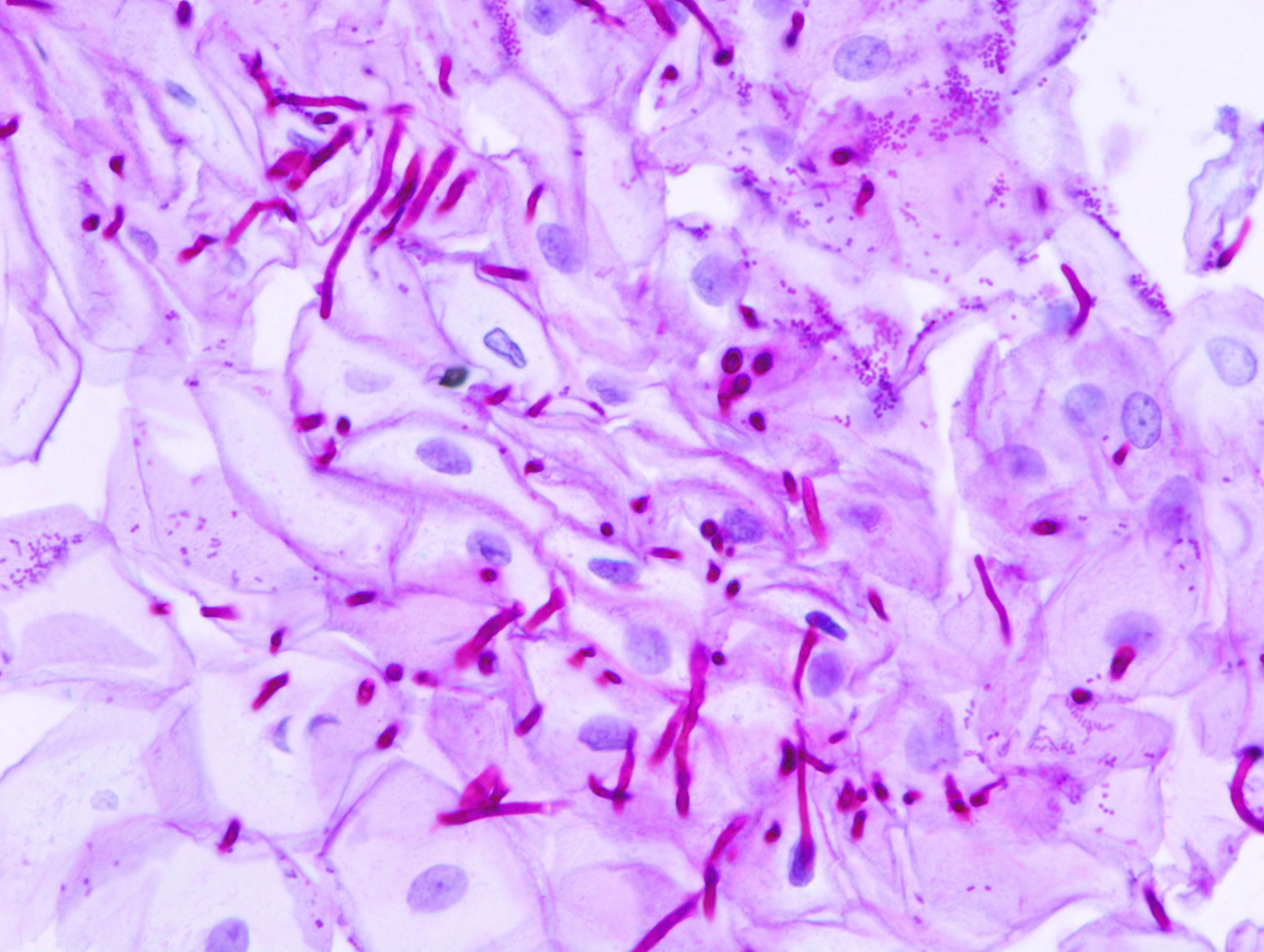 شكل دم انغراس البويضة بالصور 2560px-Esophageal_candidiasis_%282%29_PAS_stain