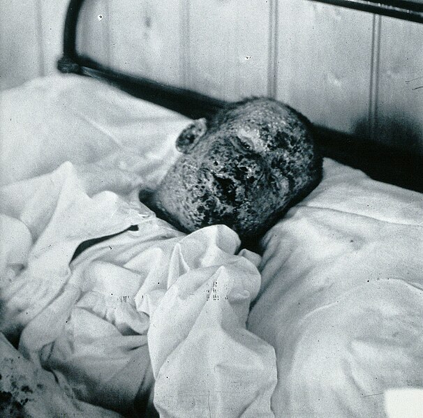 File:Gloucester smallpox epidemic, 1896; Henry Wicklin, aged 6 Wellcome V0031456 (cropped).jpg
