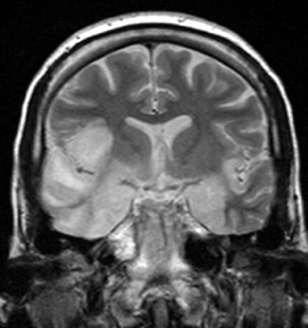MRI scan image shows high signal in the temporal lobes and right inferior frontal gyrus in someone with herpes simplex encephalitis.