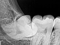 Radiografie a unui moș de minte drept inferior impactat cu orientare orizontală