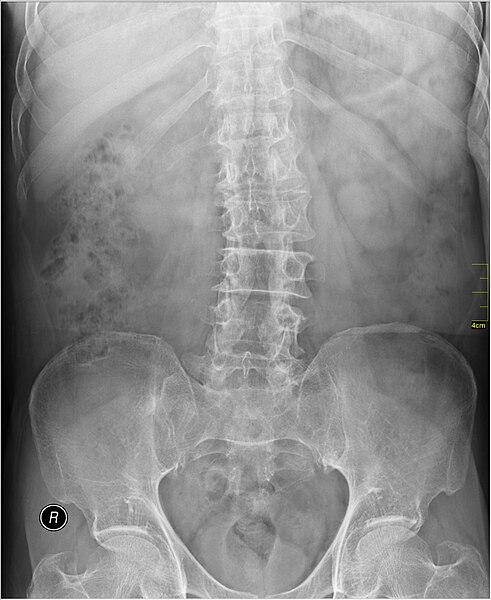 File:Medical X-Ray imaging OWA06 nevit.jpg
