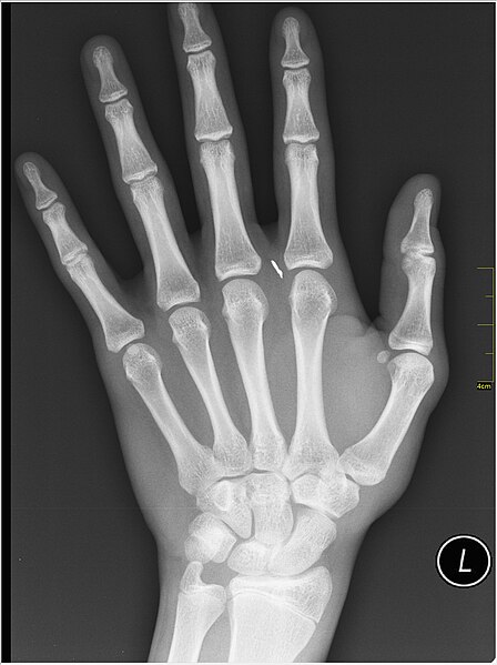 File:Medical X-Ray imaging ROA07 nevit.jpg