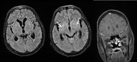 Miniatura para Meningitis fúngica