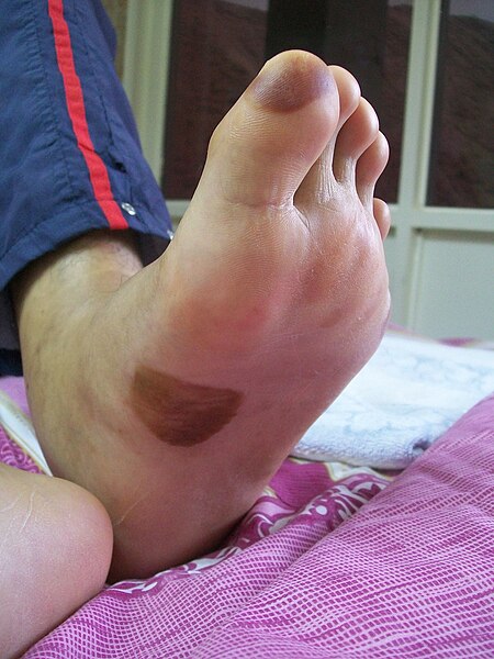 File:Osler Spots foot.jpg