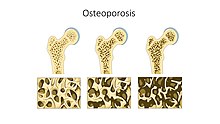 Osteoporosis -- Smart-Servier.jpg