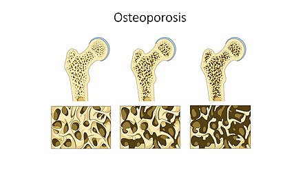 Osteoporosis -- Smart-Servier.jpg