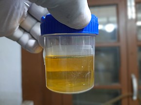 Urine sample for Culture and Sensitivity.jpg