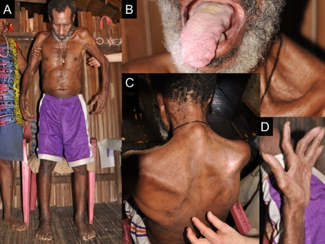 A man with amyotrophic lateral sclerosis (ALS). (A) He needs assistance to stand. (B) Advanced atrophy of the tongue. (C) There is upper limb and truncal muscle atrophy with a positive Babinski sign. (D) Advanced thenar muscle atrophy. ALS clinical picture.png