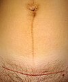 Cicatrice d'une césarienne (ligne horizontale rouge) et Linea nigra chez une femme de trente-et-un ans, sept semaines après l’accouchement.