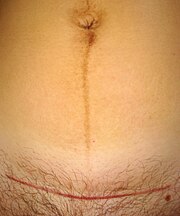 Cesarean section scar and linea nigra