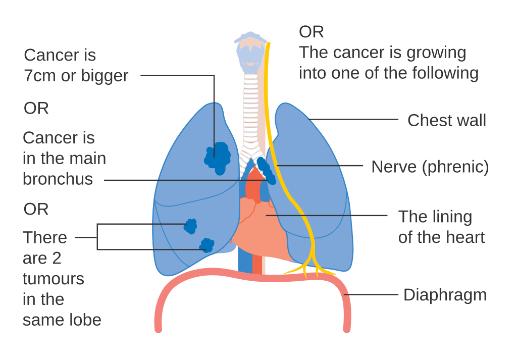 File Diagram Showing One Option For Stage 2bb Lung Cancer