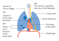 Diagram showing one option for stage 2Bb lung cancer CRUK 177.svg