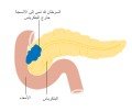 Diagram showing stage T3 cancer of the pancreas CRUK 261-ar.svg