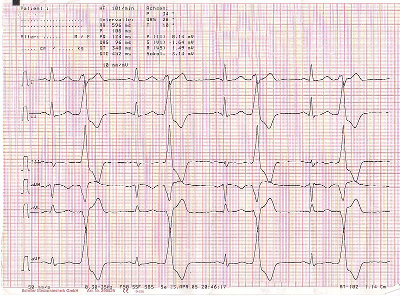 File:Ekg bigeminus bionerd.jpg