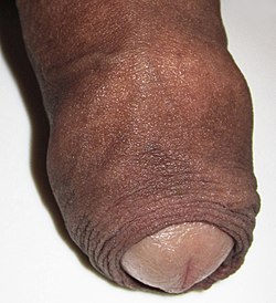 Foreskin of a human penis.jpg