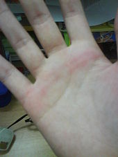 A picture showing the marks left on a female student's palm after being caned Hand caning.jpg