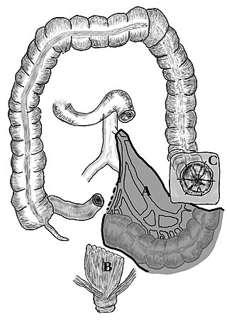 <span class="mw-page-title-main">Hartmann's operation</span> Surgical resection of the large intestine