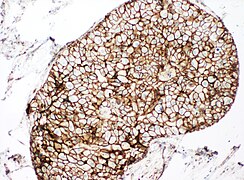 Immunohistochemistry for p120 in ductal carcinoma in situ.jpg