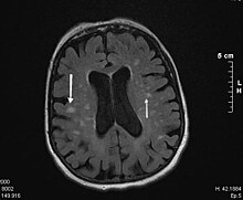 Subkortikale Arteriosklerotische Enzephalopathie Wikipedia