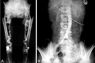 <span class="mw-page-title-main">Aortography</span> Medical procedure