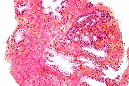 ไฟล์:Prostata adenocarcinoma.jpg