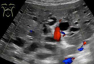 Abdominal ultrasonography (with Doppler) of dilated intrahepatic bile ducts, in this case because of pancreatic cancer. The bile ducts are colorless (black) in contrast to blood vessels (portal vein near center, and hepatic artery to the right of it) which have Doppler signal. Ultrasonography of dilated bile ducts.jpg