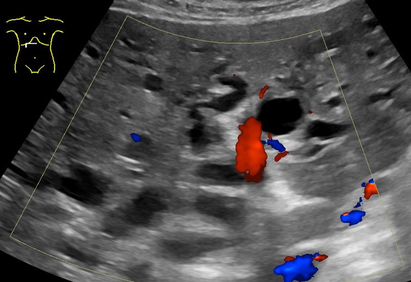 File:Ultrasonography of dilated bile ducts.jpg