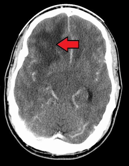 GBM in the frontal right lobe as seen on CT scan