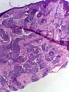 Tuberculoid leprosy Medical condition