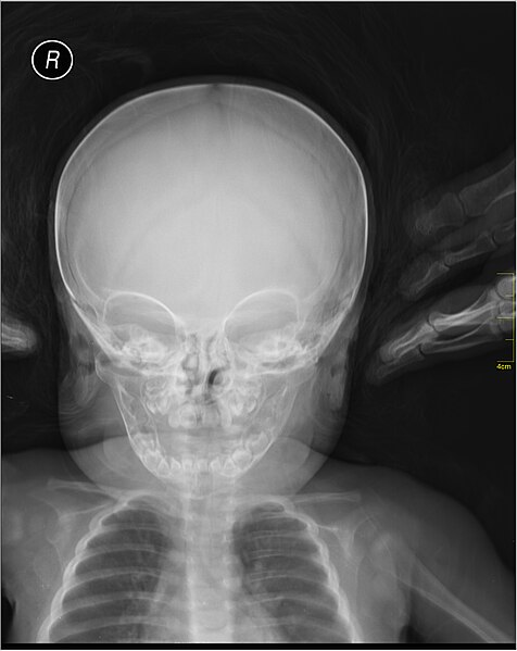 File:Medical X-Ray imaging RXA07 nevit.jpg